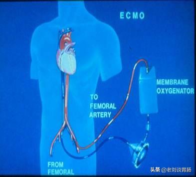 ecmo醫學上是什么意思
